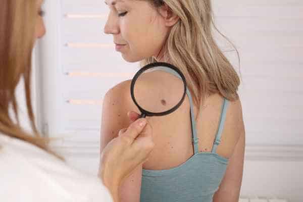 What Are Traditional Skin Lesion Removal Methods Folkestone?