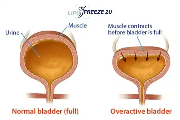 diagram of overactive bladder treatment Folkestone