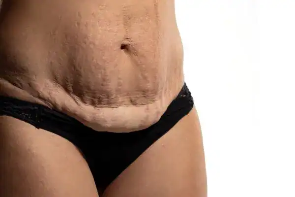 loose skin after weight loss injections Folkestone