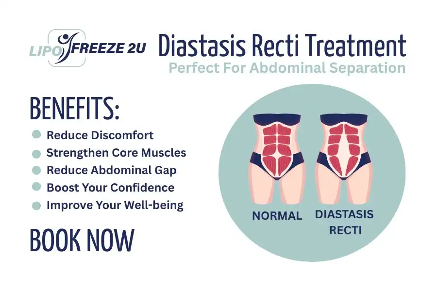 How Long Will It Take to See Improvements in Diastasis Recti Folkestone
