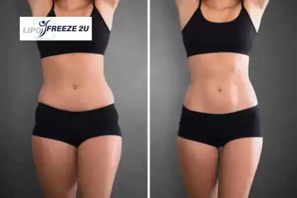 How Can LIPO FREEZE 2U Support Your Post-Pregnancy Body Recovery Folkestone?