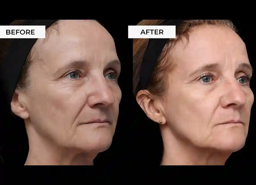 How Many RF Microneedling Sessions Will You Need to See a Difference Folkestone?