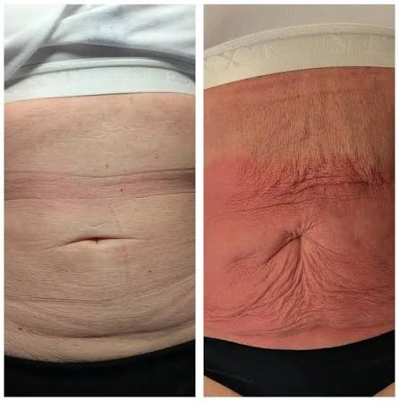 How Does RF Microneedling Improve Crepey, Thin and Uneven Skin Texture Folkestone?