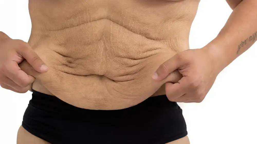 RF Microneedling for Loose Skin: How Can It Help Tighten and Reshape the Skin Folkestone?